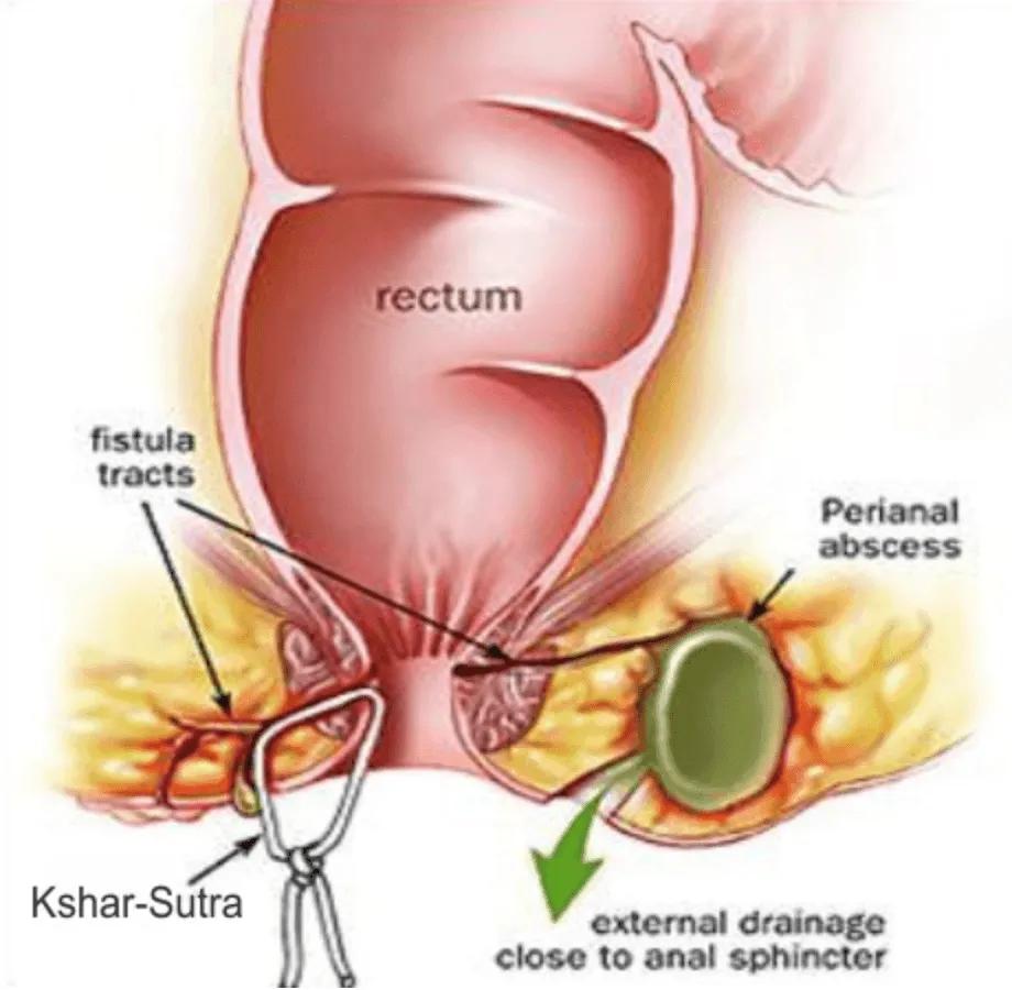 Ksharsutra Anorectal Care